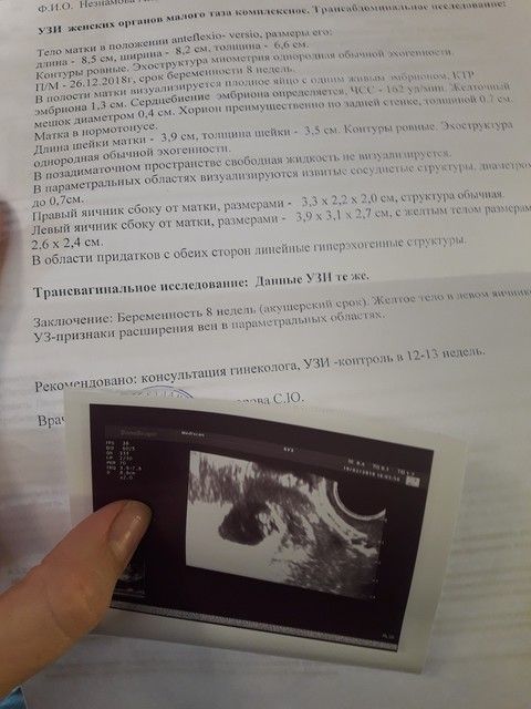 УЗИ. 8 недель. УЗИ. 8 недель.