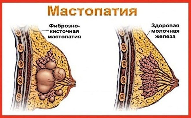 Фиброзно-кистозная мастопатия: симптомы и лечение Фиброзно-кистозная мастопатия: симптомы и лечение