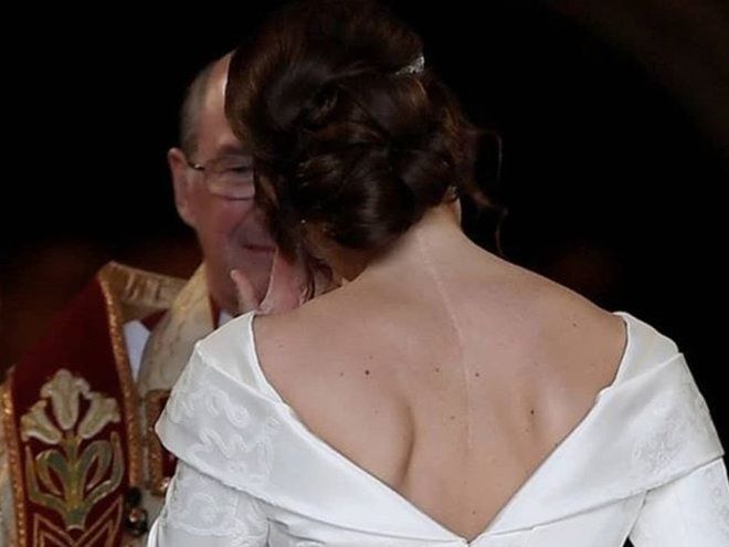 Свадебное платье принцессы Евгении открывает шрам от операции на спине