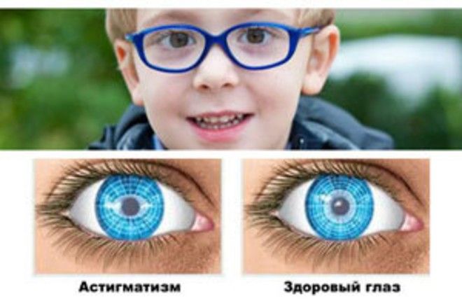 Астигматизм у детей: как определить и вылечить Астигматизм у детей: как определить и вылечить